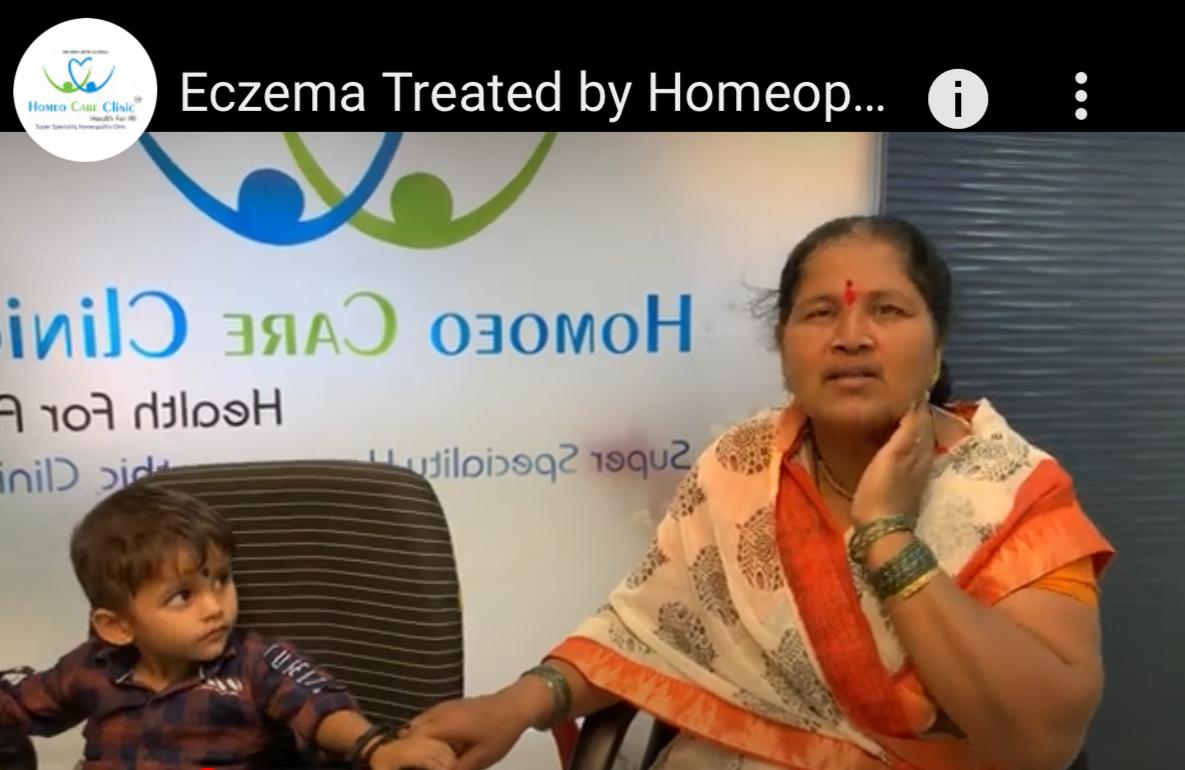 Homeopathy treatment for eczema recovery