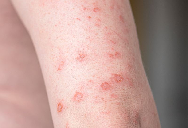 Eczema Treated with Homeopathic Medicine