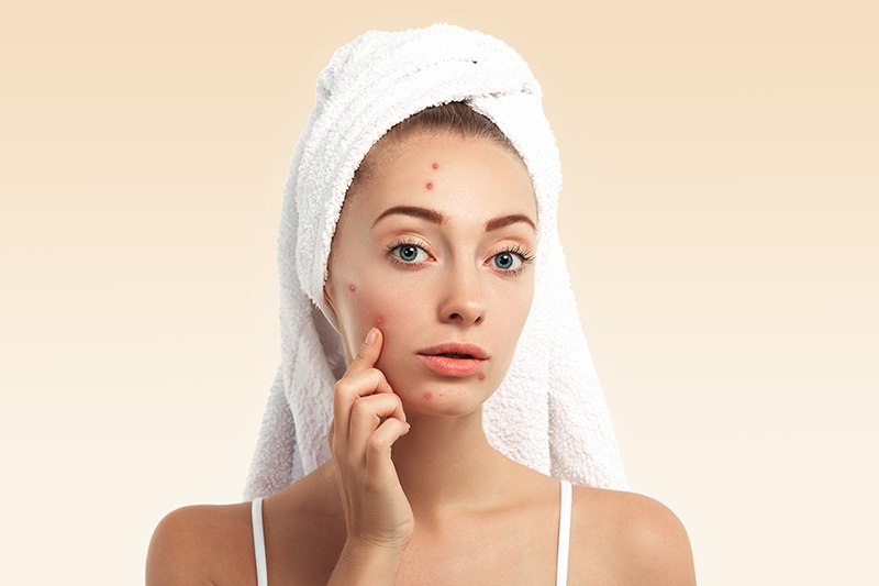 Homeopathy Treatment on Skin Acne Pimples