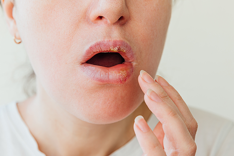 Homeopathic Treatment for Mouth Ulcers
