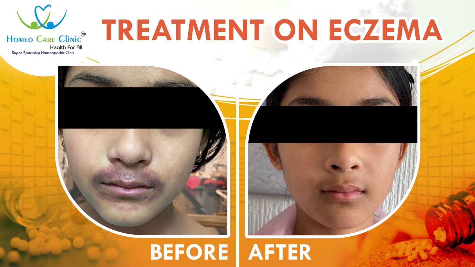 Recovers From Recurring Eczema by Homeopathy