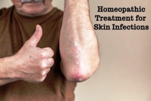 Homeopathic Treatment for Skin Infections