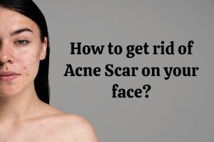 How to get rid of Acne Scar on your face?