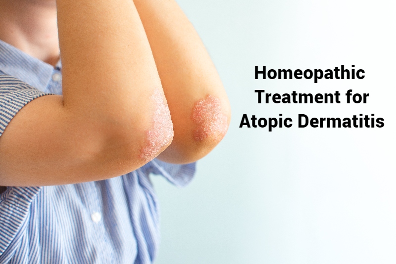 Atopic Dermatitis