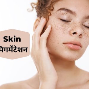 Homeopathic Skin Pigmentation Treatment