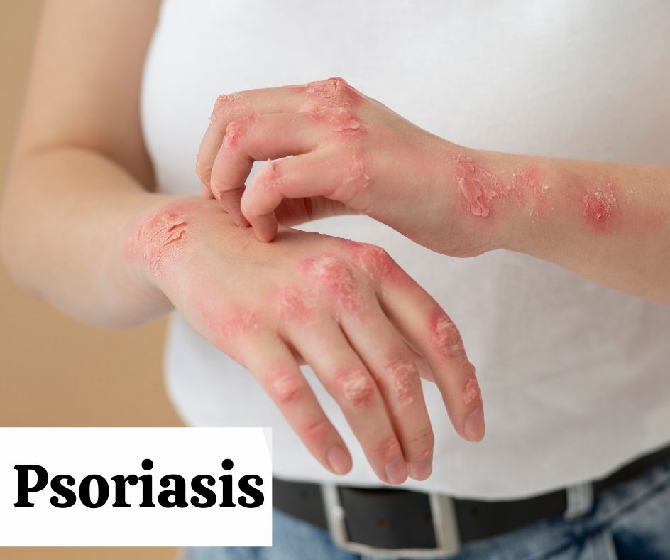 Psoriasis homeopathy relief