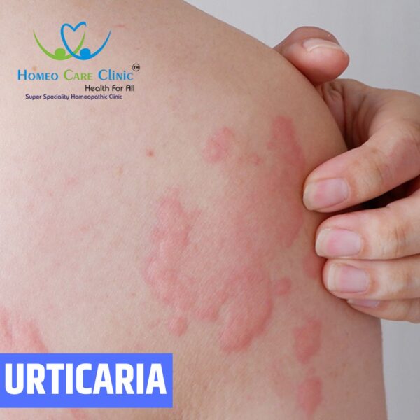 Urticaria