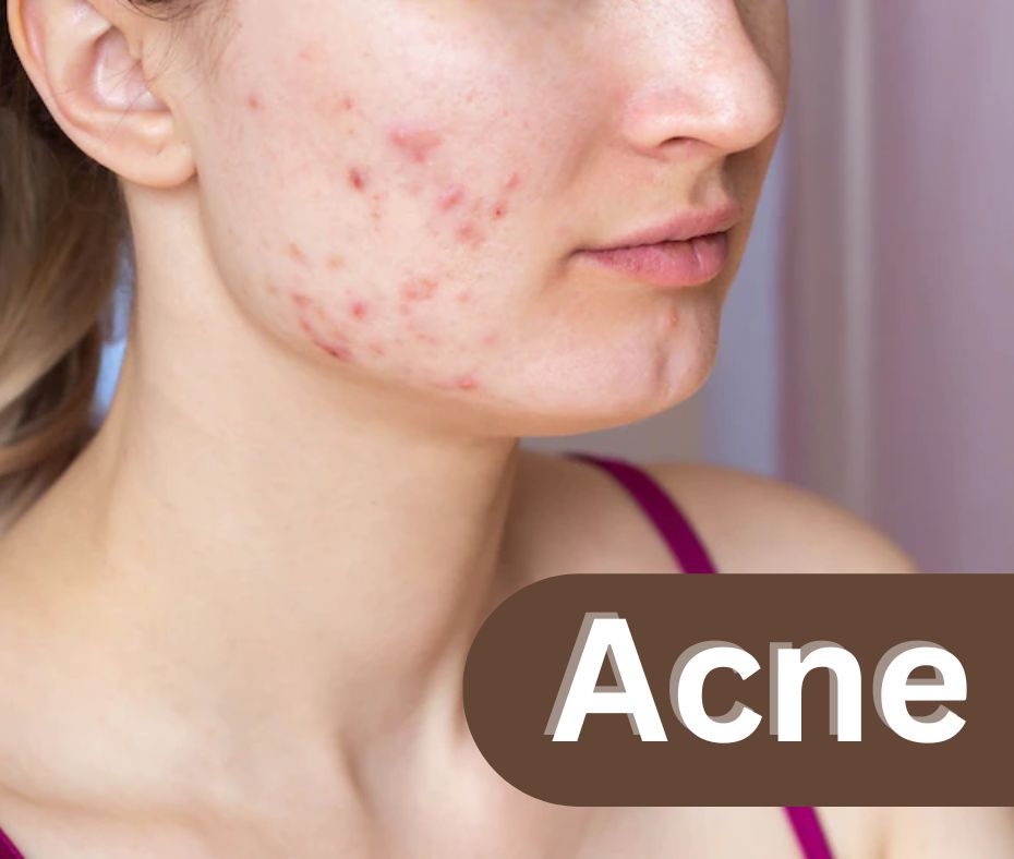 Acne Homeopathic Treatment
