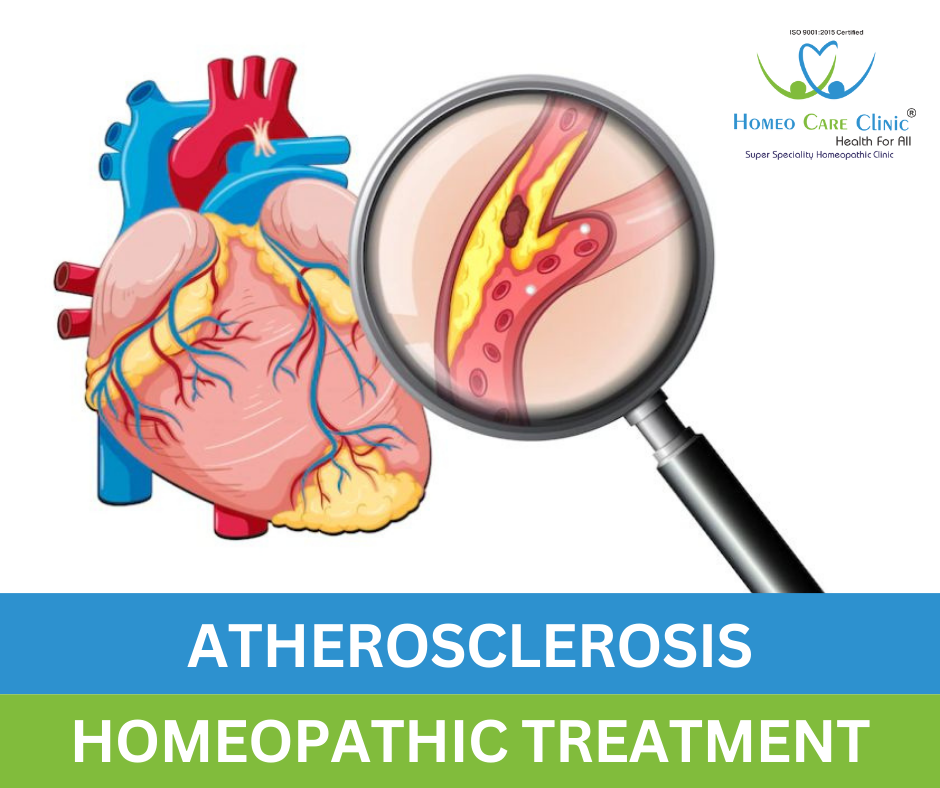 homeopathic approach to treating atherosclerosis