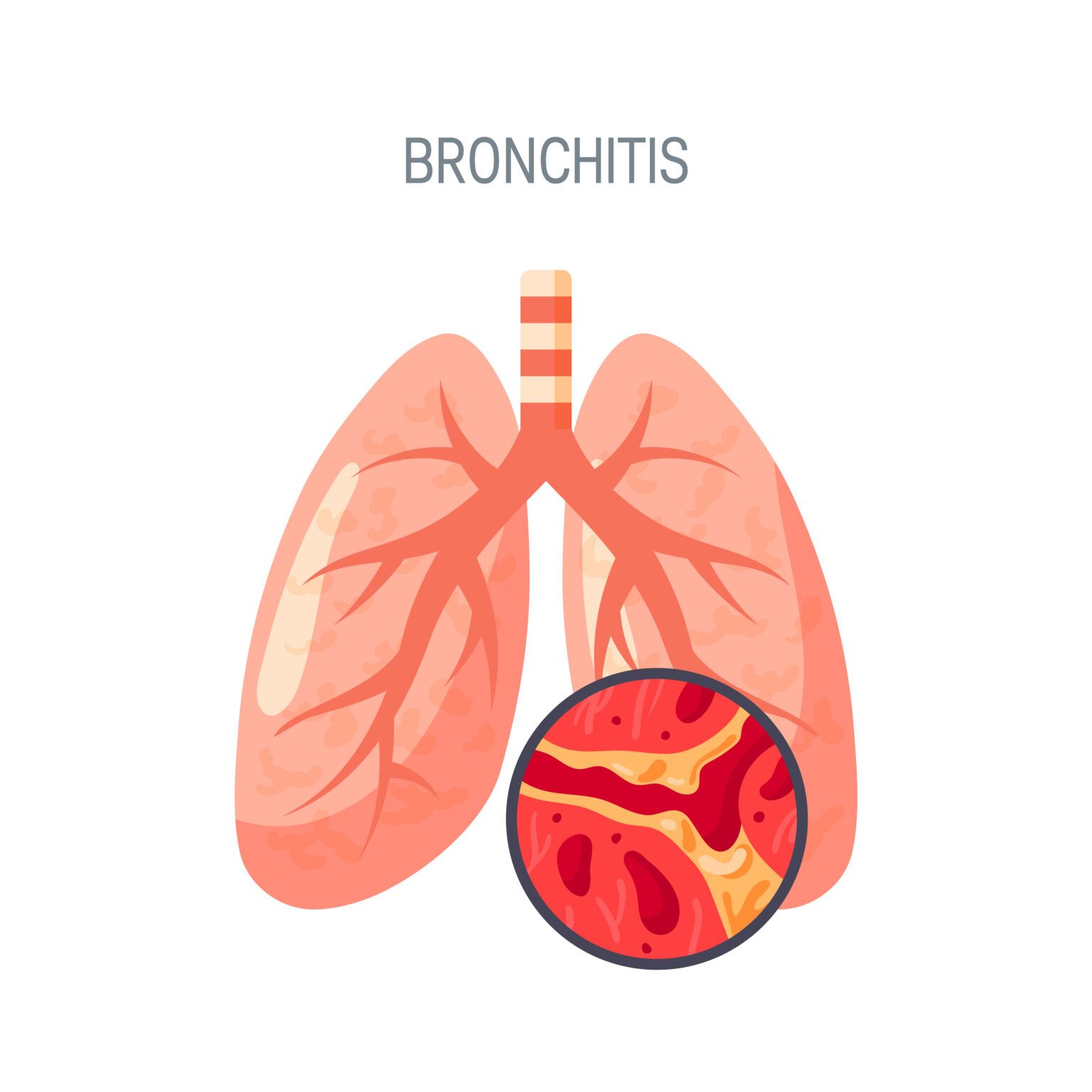 BRONCHITIS