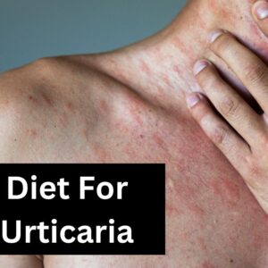 Diet For Urticaria