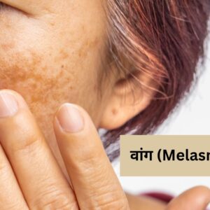 Melasma