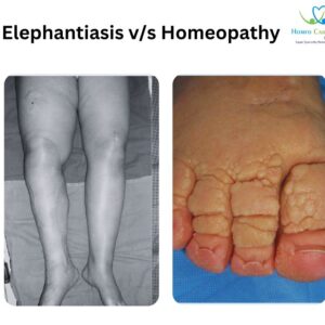 Elephantiasis Homeopathy