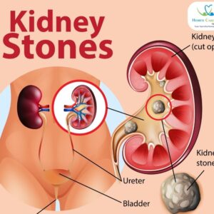 Kidney Stone Homeopathic Medicines