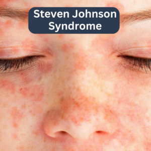 Steven Johnson Syndrome - Homeo Care Clinic, Hadapsar