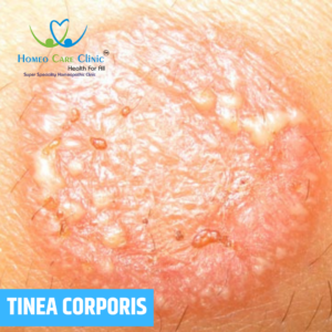 Tinea Corporis