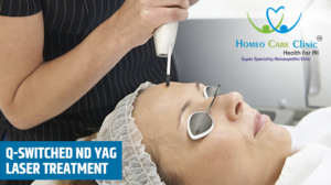 Q switched Nd YAG laser Treatment