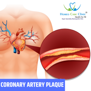 coronary artery plaque Treatment