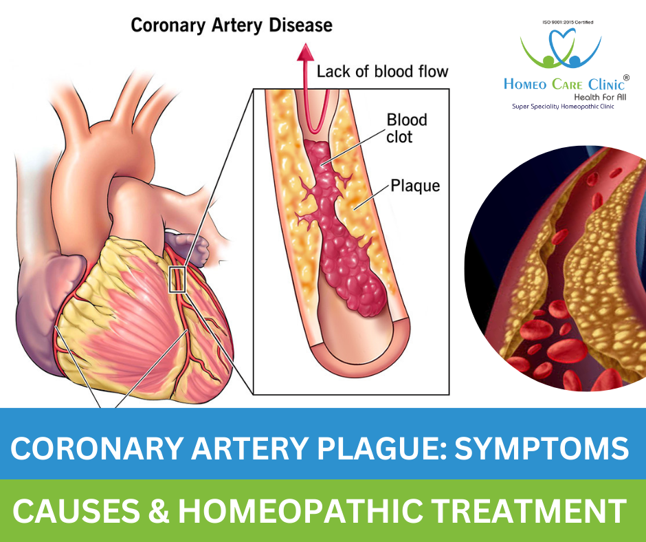 coronary artery plaque in the heart