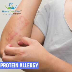 Protein allergy homeopathy