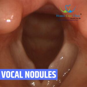 Vocal Nodules