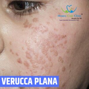 Verruca plana homeopathy