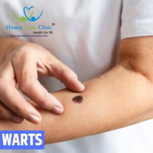 Natural homeopathic remedies for treating genital warts.