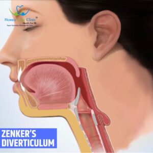 Zenker's Diverticulum