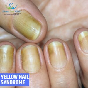 Yellow Nail Syndrome