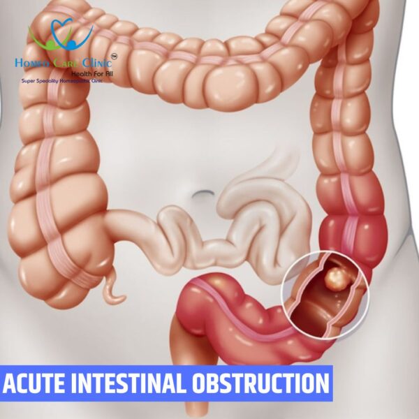 Acute Intestinal Obstruction