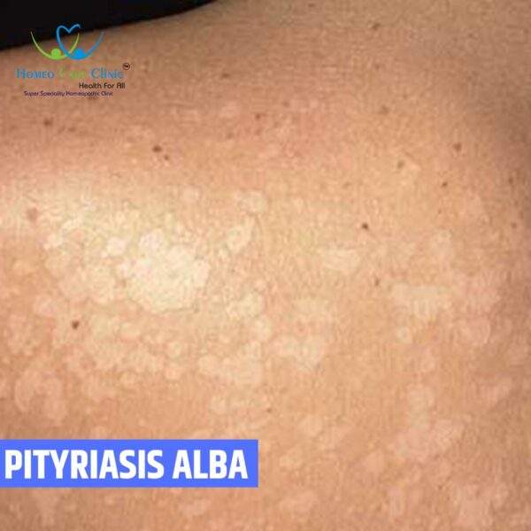 Pityriasis Alba Homeopathy Treatment