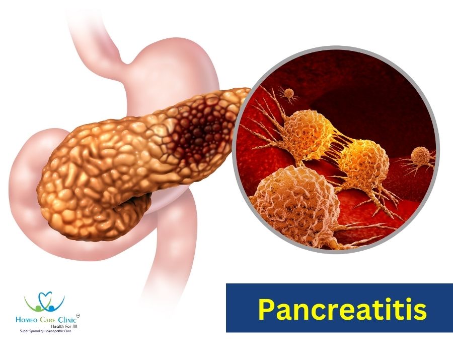 Homeopathic treatment for pancreatitis with natural remedie