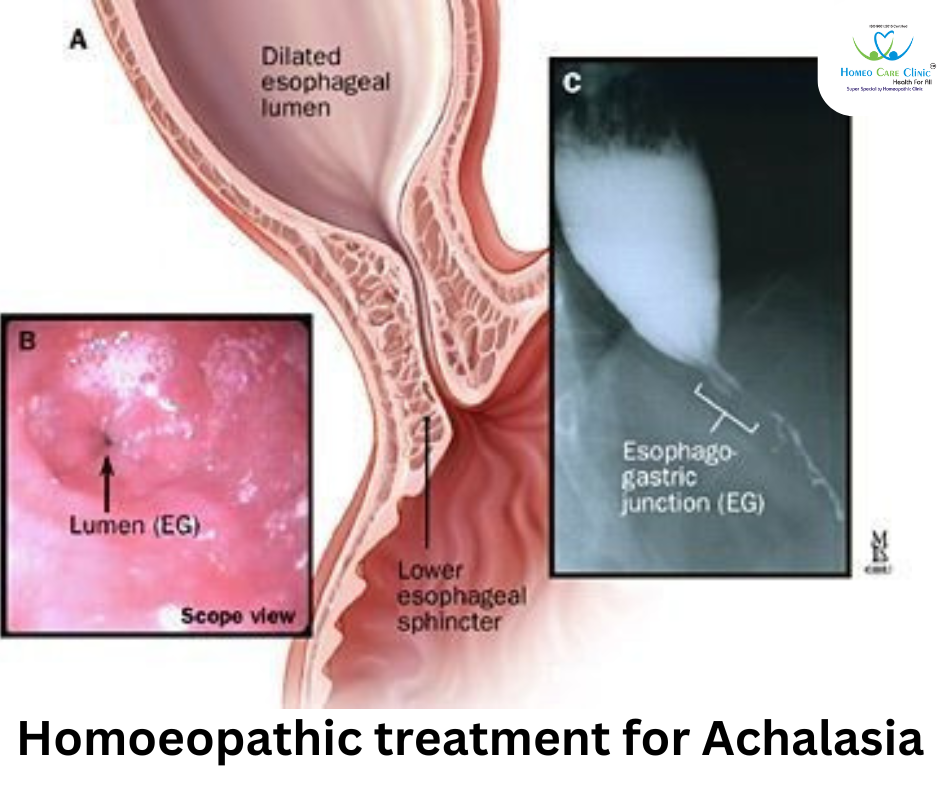 Achalasia Cardia and Its Homeopathic Treatment