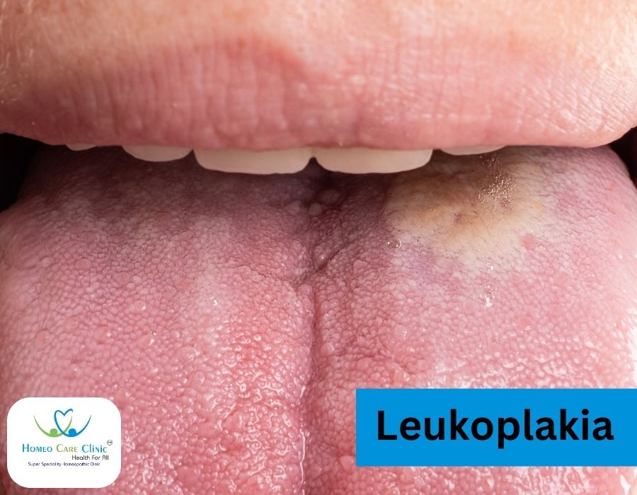 Leukoplankia symptoms and causes