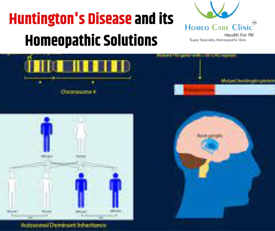 Huntingtons Disease Homeopathic Solutions