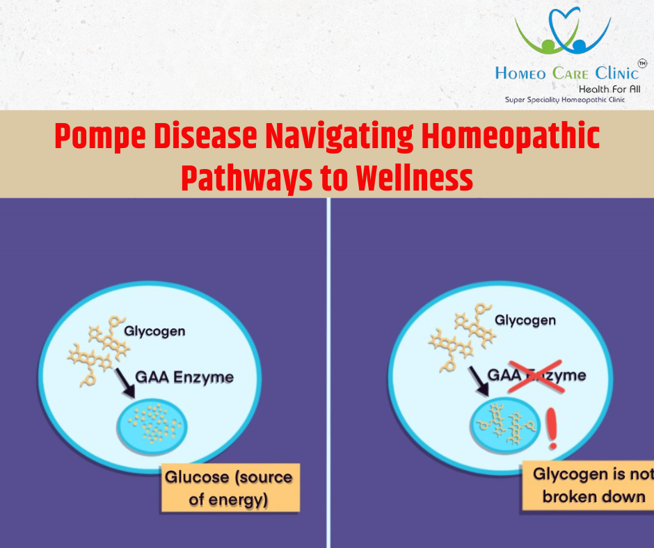 Pompe Disease Navigating Homeopathic