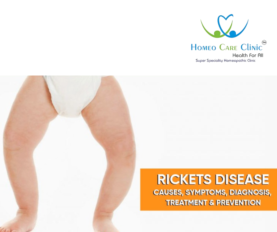 Homoeopathic treatment for Rickets