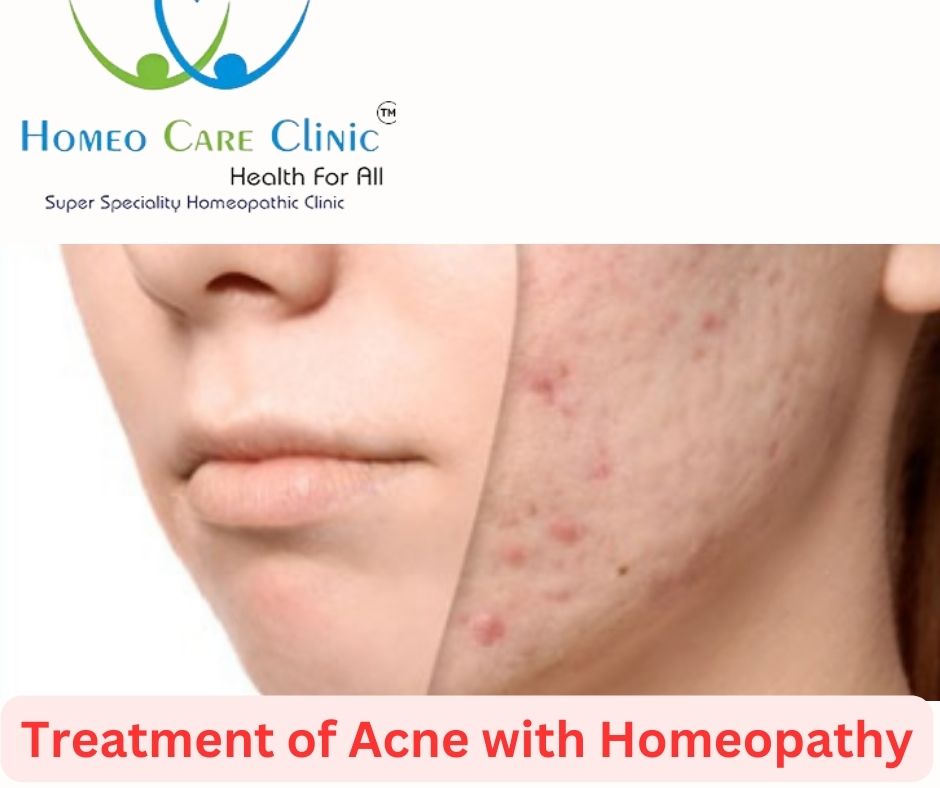 Acne Treatment