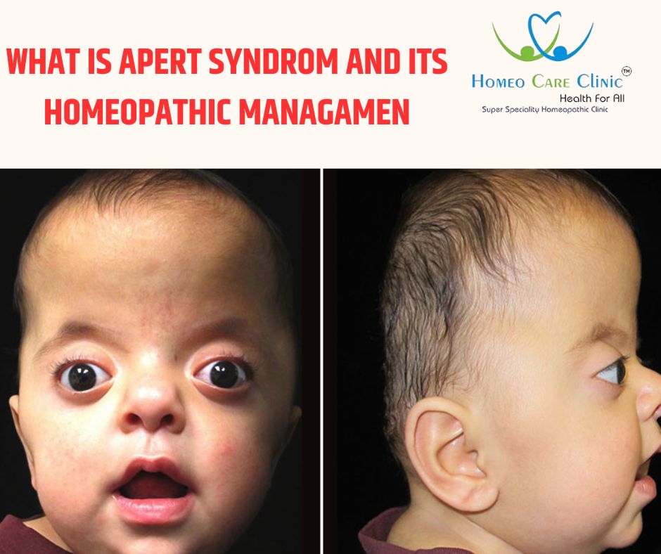 Syndrom homeopathic managamen