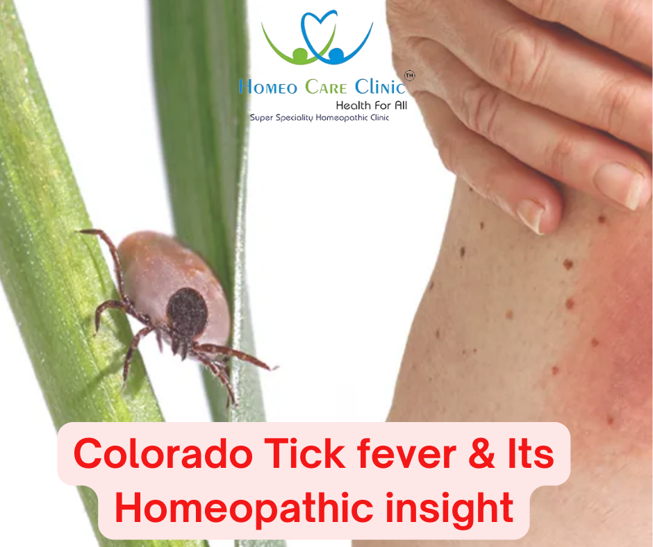 Colorado Tick Fever Treatment