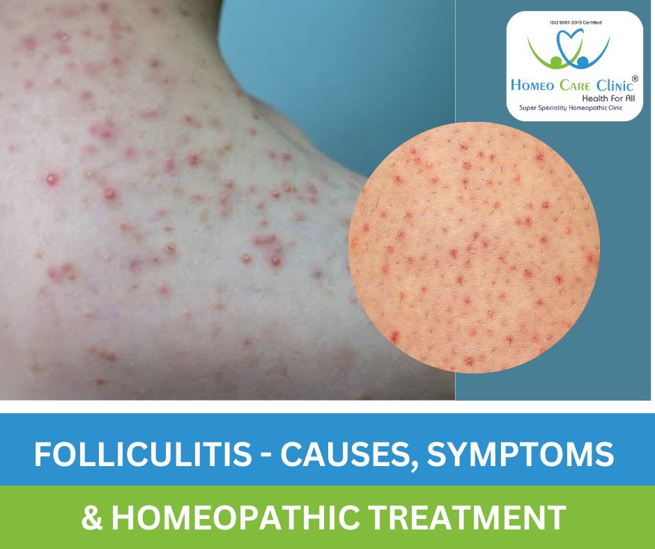 Folliculitis homeopathic remedies