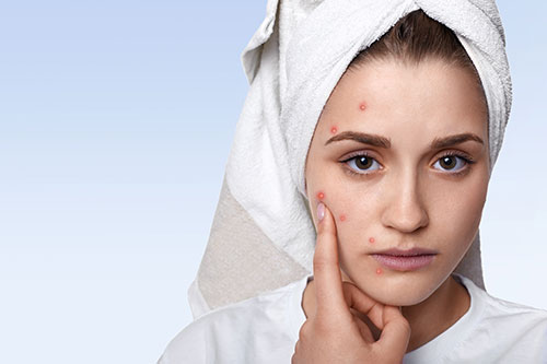 Acne/ Pimples Treatment