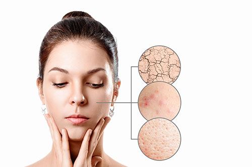 Acne/Pimples Scars Treatment