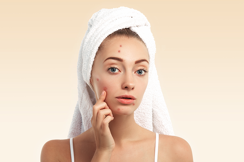 Acne/Pimples Scars Treatment