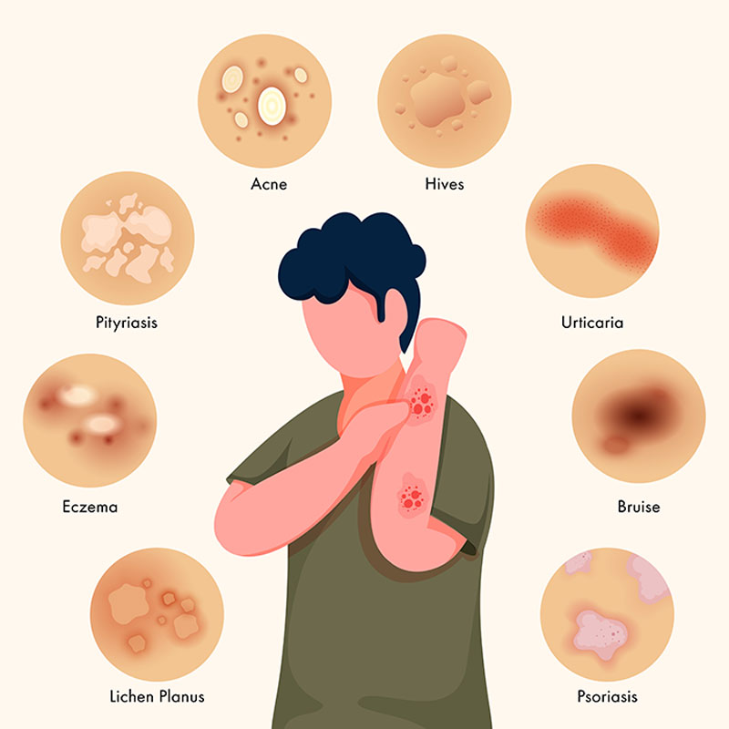 Diet Chart For Fungal Infection