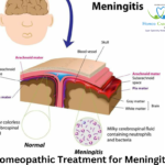 Meningitis