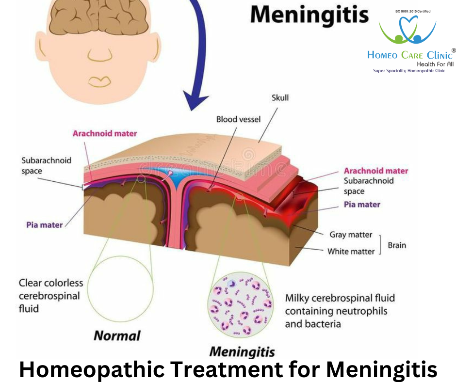 Meningitis