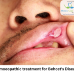 Behcet's disease symptoms