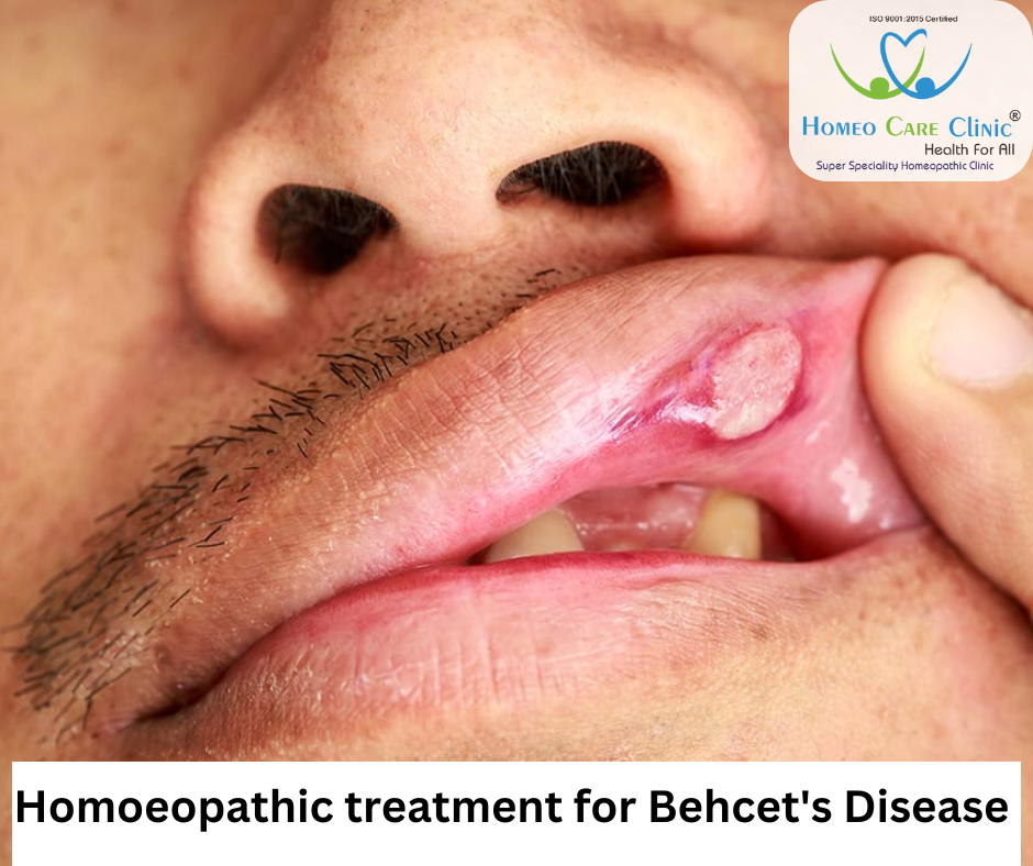 Behcet's disease symptoms