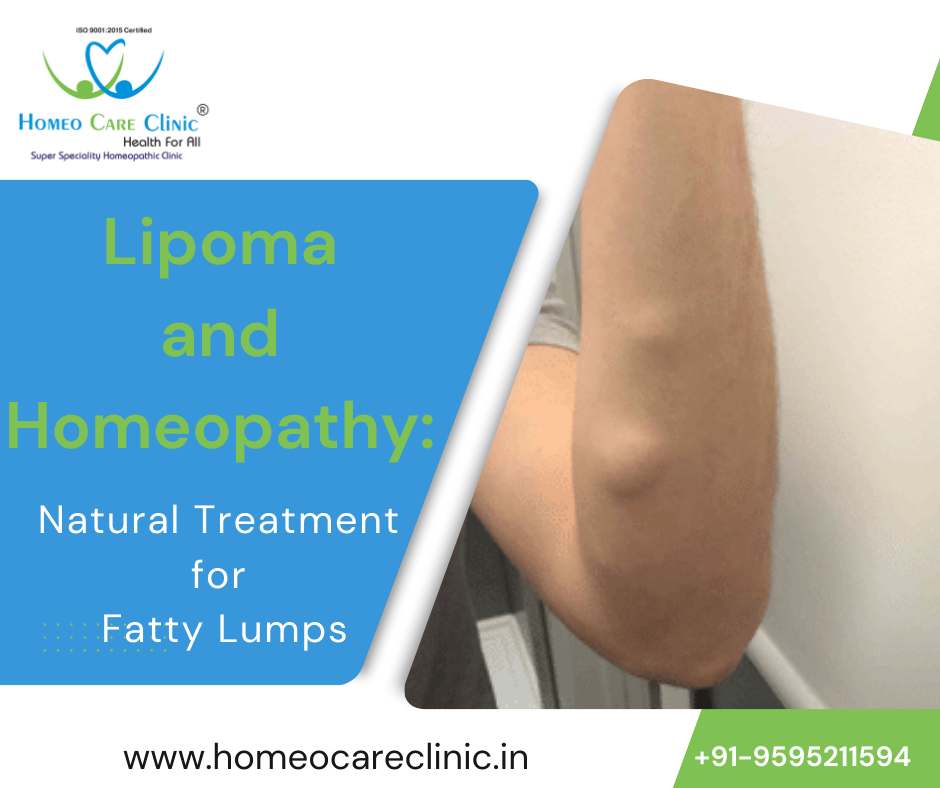 lipoma treatment in homeopathy